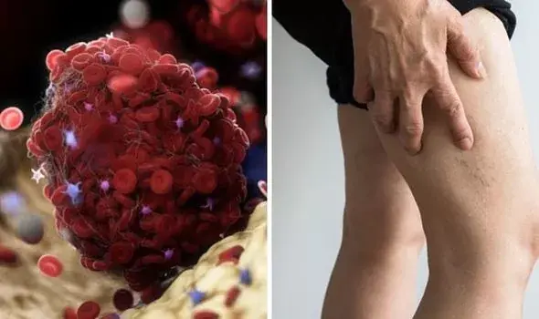 Blood Clot in Leg: Signs and Symptoms You Shouldn’t Ignore