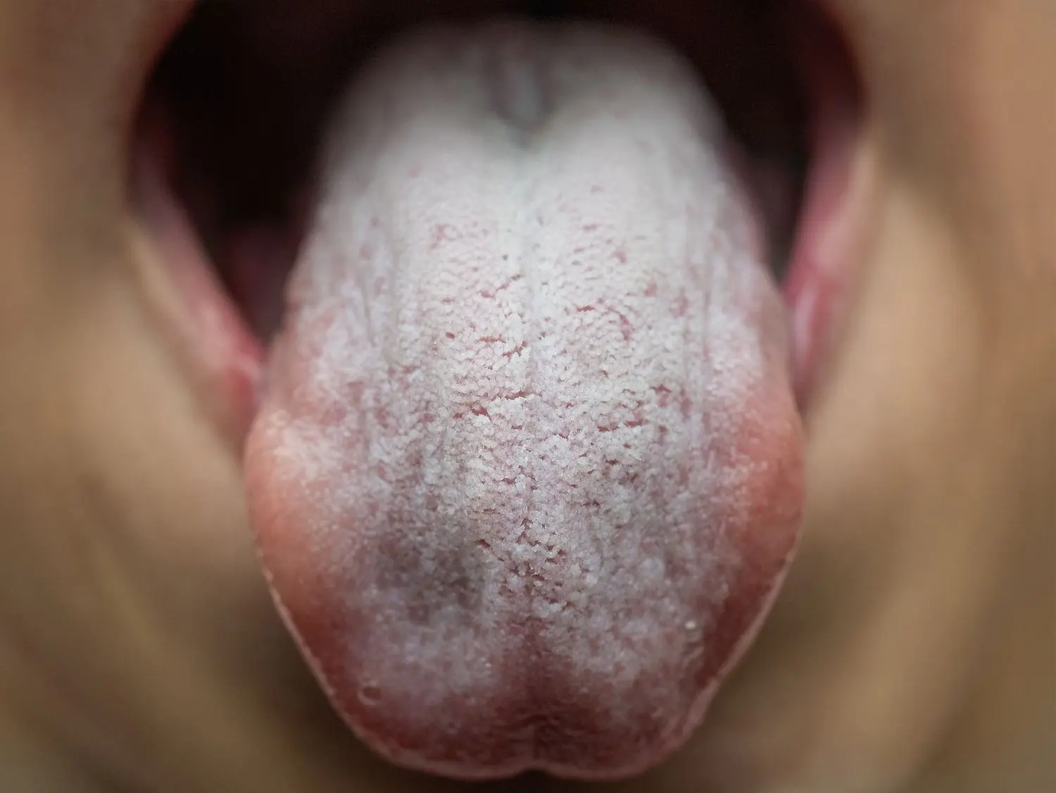 Top Signs That You Have Candida Infection and What to Do About It