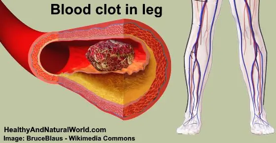 Blood Clot in Leg: Signs and Symptoms You Shouldn’t Ignore (Pictures Included)