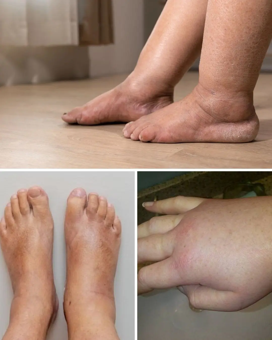 Foods that can ease swelling in hands and feet
