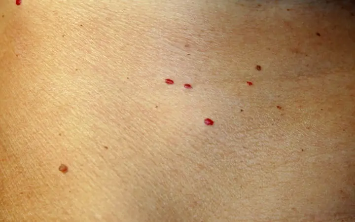 What Those Red Spots on Your Skin Are Warning You About and How to Remove Them Naturally