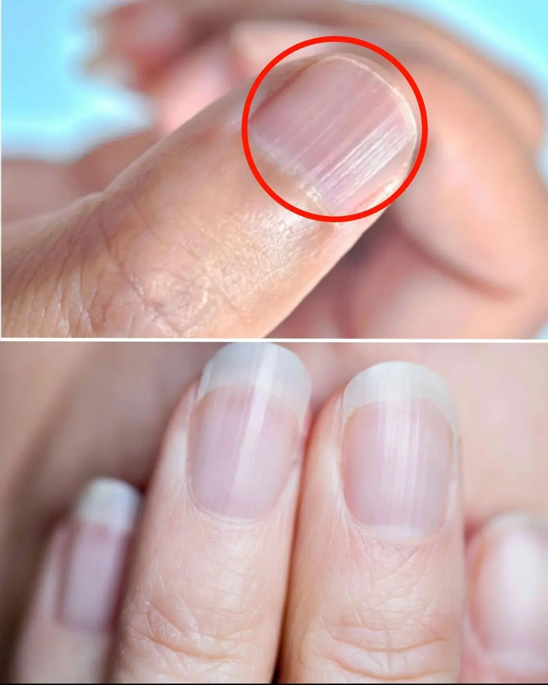 What Do Vertical Nail Ridges Mean After 40
