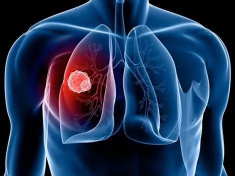 If You Notice These 7 Symptoms, Get Checked for Lung Cancer Immediately