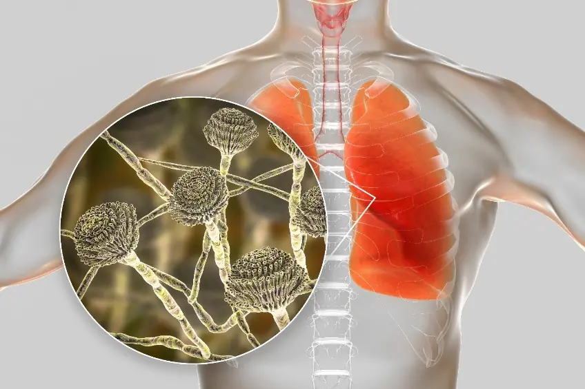10 Early Warning Signs You're Being Exposed to Mold Toxicity
