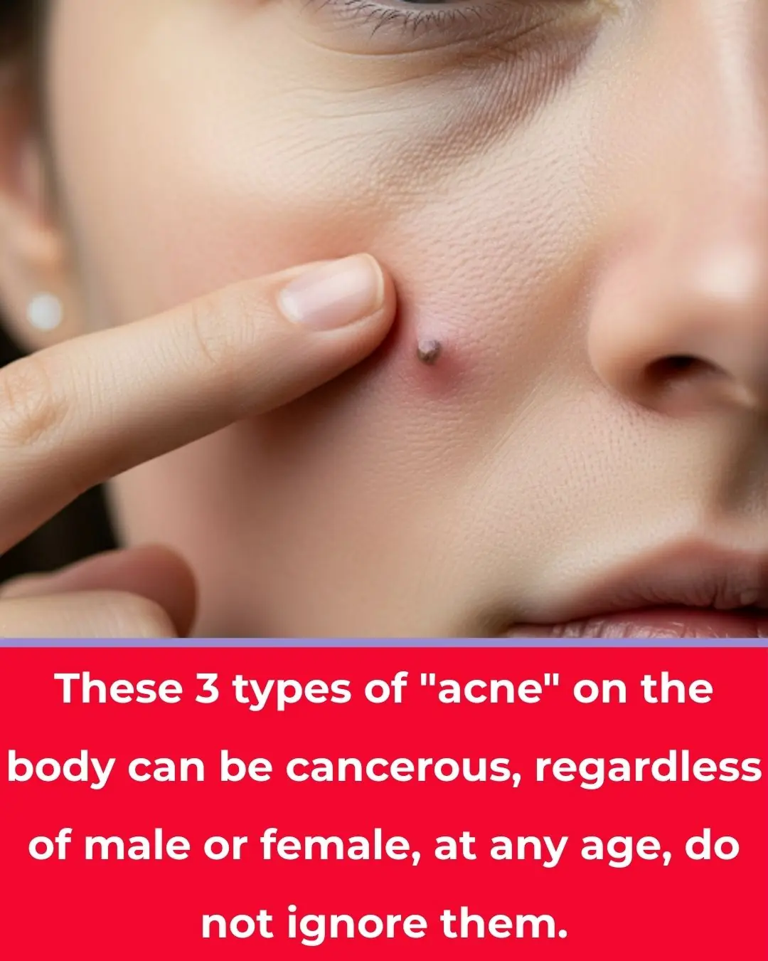 These 3 types of “acne” on the body could be cancerous; whether male or female, no matter the age, don’t ignore them.