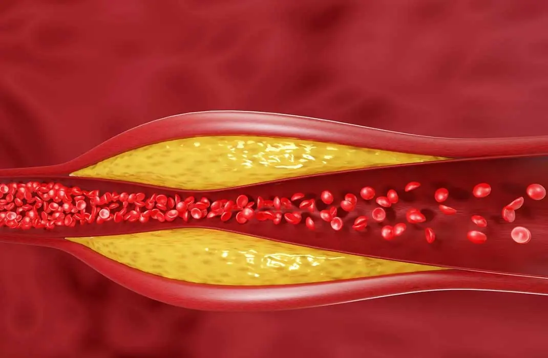 Cholesterol Meds Linked With Heart Attacks, Fast Aging And Brain Damage. Eat These Foods Instead