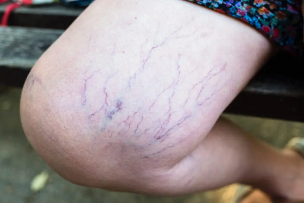 Purple Veins on Your Legs: When to Worry