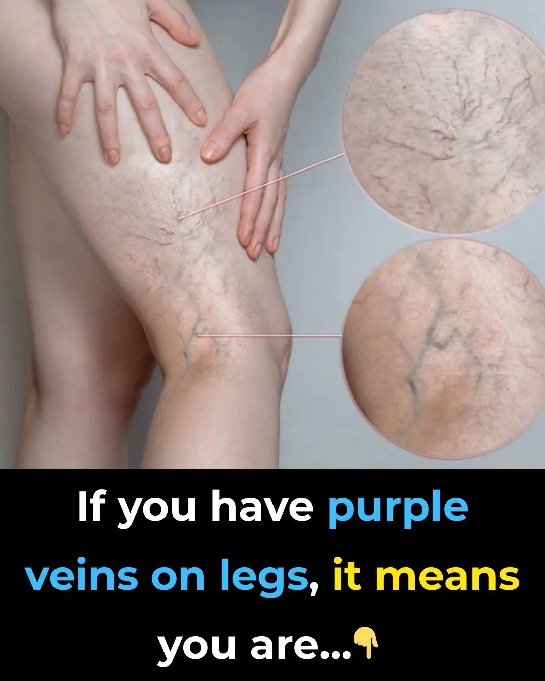Purple Veins on Your Legs
