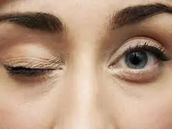 Why Does Your Eye Twitch Randomly? An Eye Doctor Explains