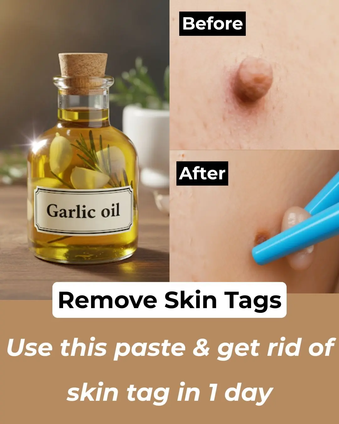 3 Home Remedies to get rid of Skin Tags – Skin Tag Removal