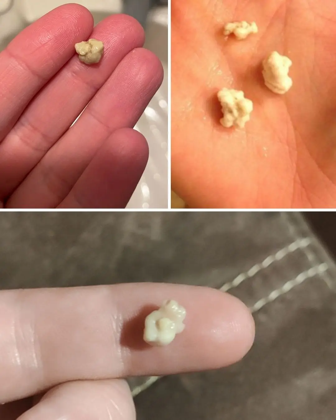 Tonsil Stones: Causes, Symptoms, and Natural Remedies