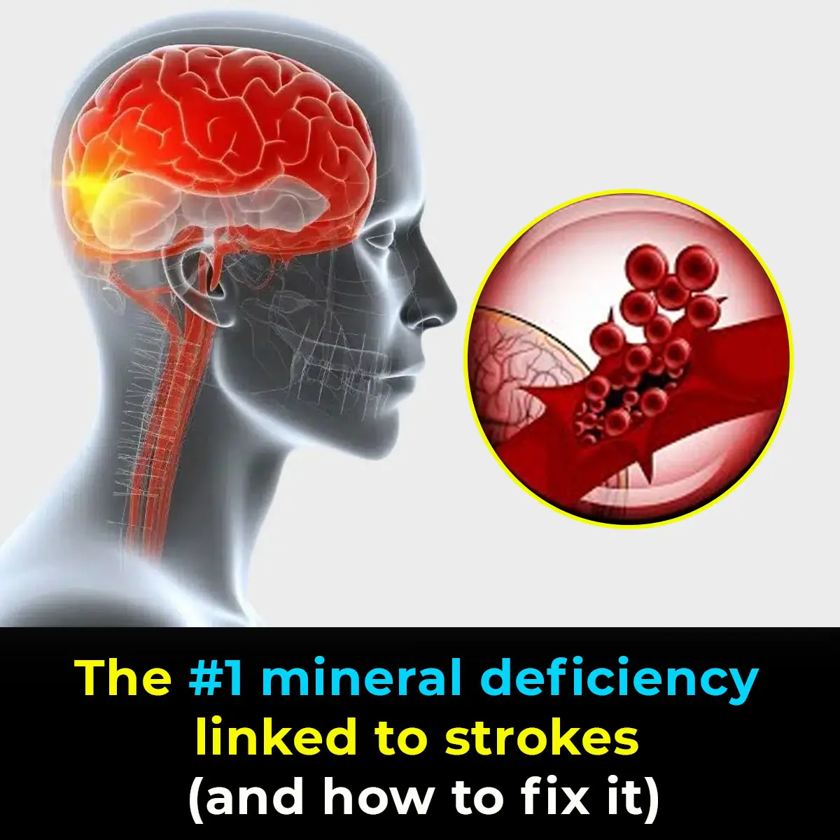 The #1 mineral deficiency linked to strokes (and how to fix it)