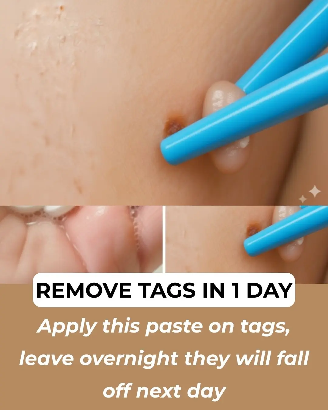 7 Natural Home Remedies To Remove Skin Tags