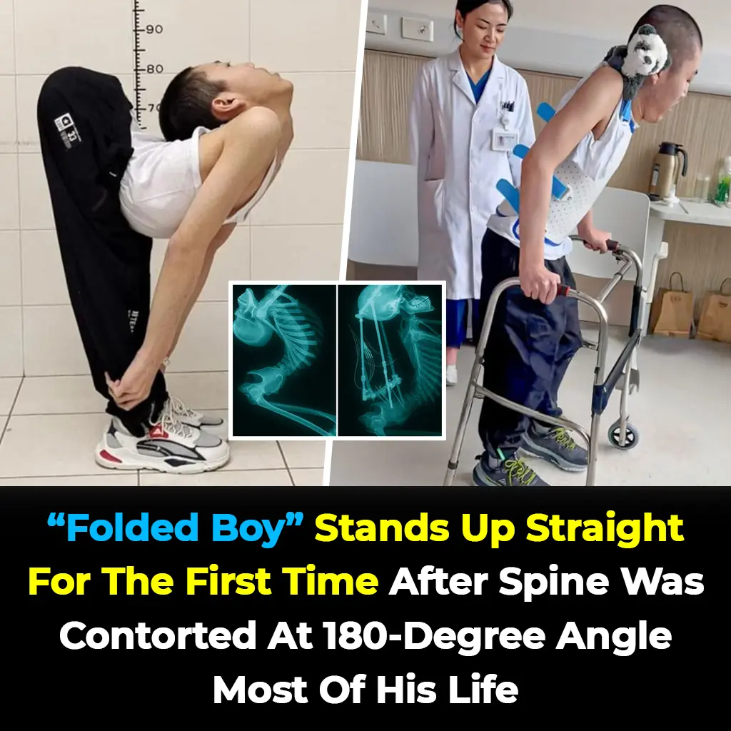 ‘Folded Boy’ Miraculously Stands Tall After Years Living With 180° Spine Bend