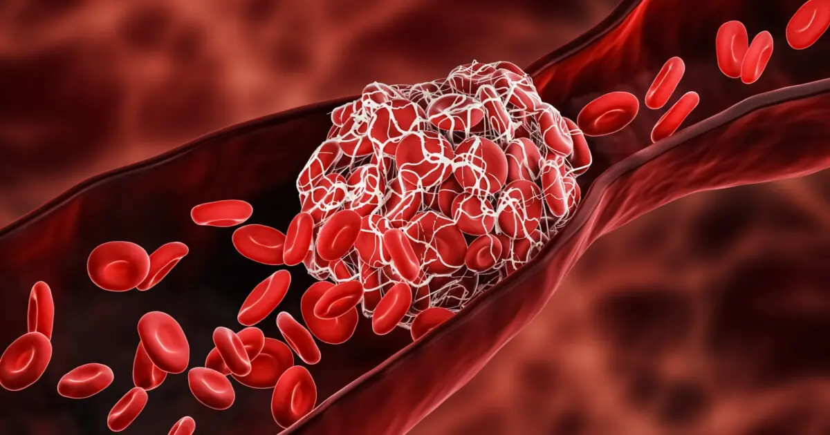 A Blood Clot Can Lead to a Heart Attack, Thrombosis, or a Stroke. Discover 16 Powerful Blood-Thinning Foods You Need