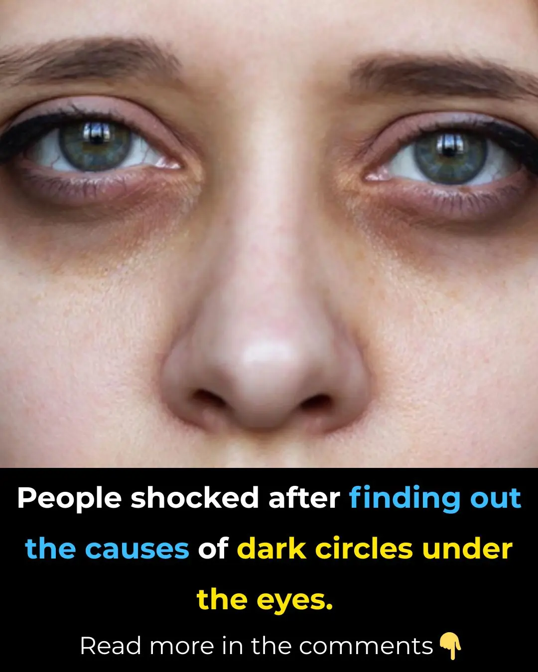 8 Reasons for Dark Circles That Aren’t Due to Lack of Sleep