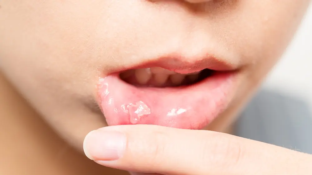 Cold Sores: How to Reduce Symptoms and Speed Up Recovery