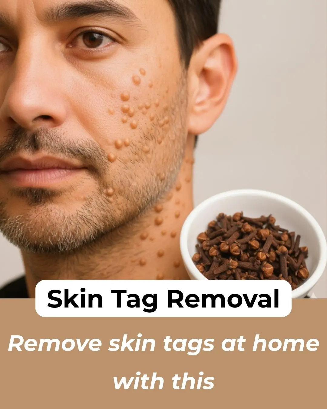 7 Natural Home Remedies To Remove Skin Tags
