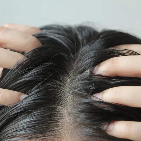 That Persistent Scalp Itch