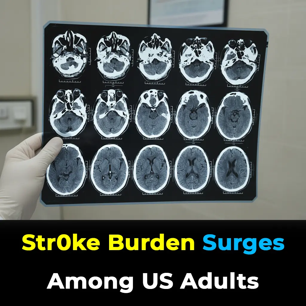 Stroke Rates Soar Among US Adults: Experts Warn of Alarming Trend