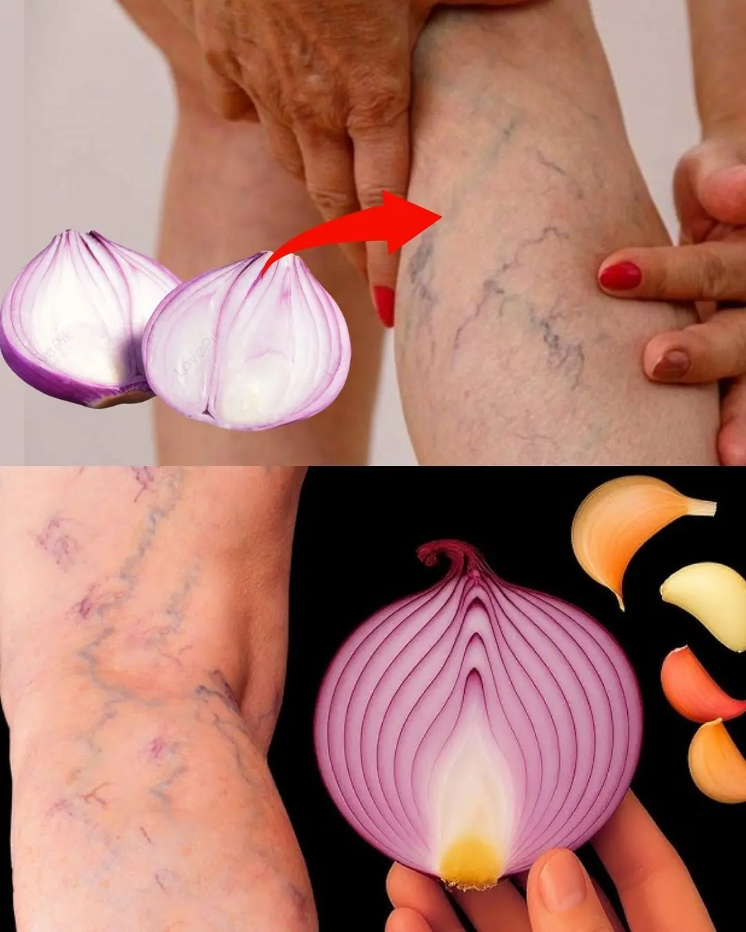✨ Unbelievable! This Is a Vein Killer! Erase Varicose Veins Like an Eraser! 🔝 2 Natural Recipes 🤩