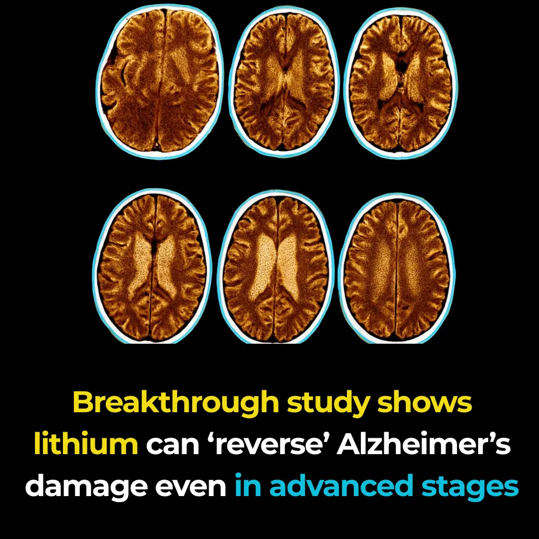 Breakthrough study shows lithium can ‘reverse’ Alzheimer’s damage even in advanced stages