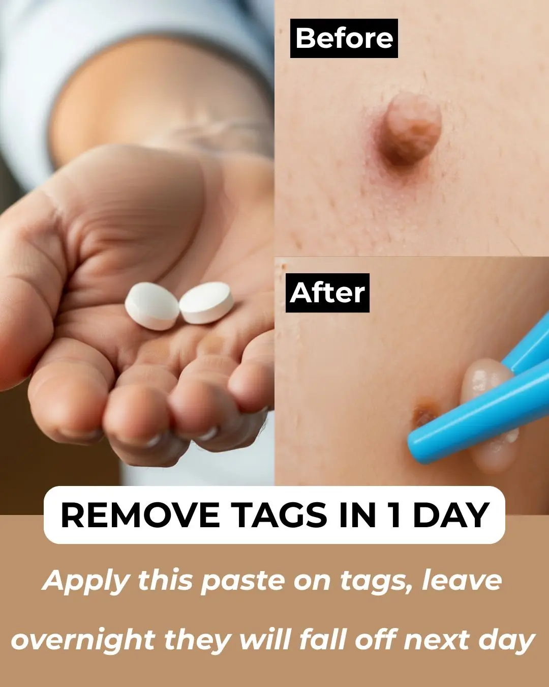 7 Natural Home Remedies To Remove Skin Tags