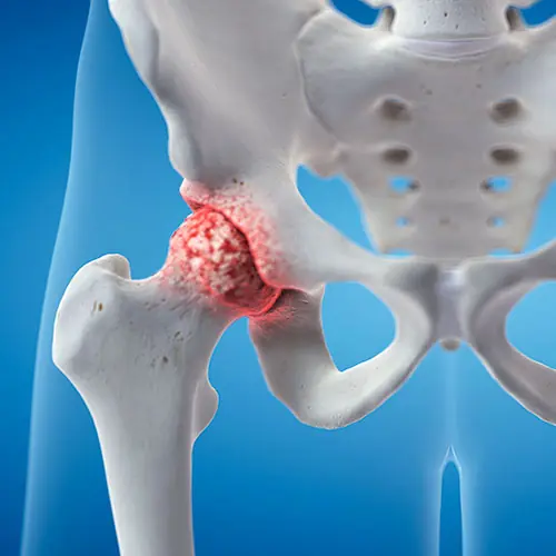 Top 3 Vitamins for Hip Arthritis