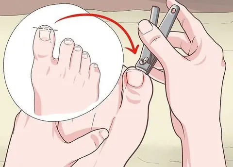The Simple Trick to Get Rid of Ingrown Toenails Fast—You’ll Wish You Knew Sooner!