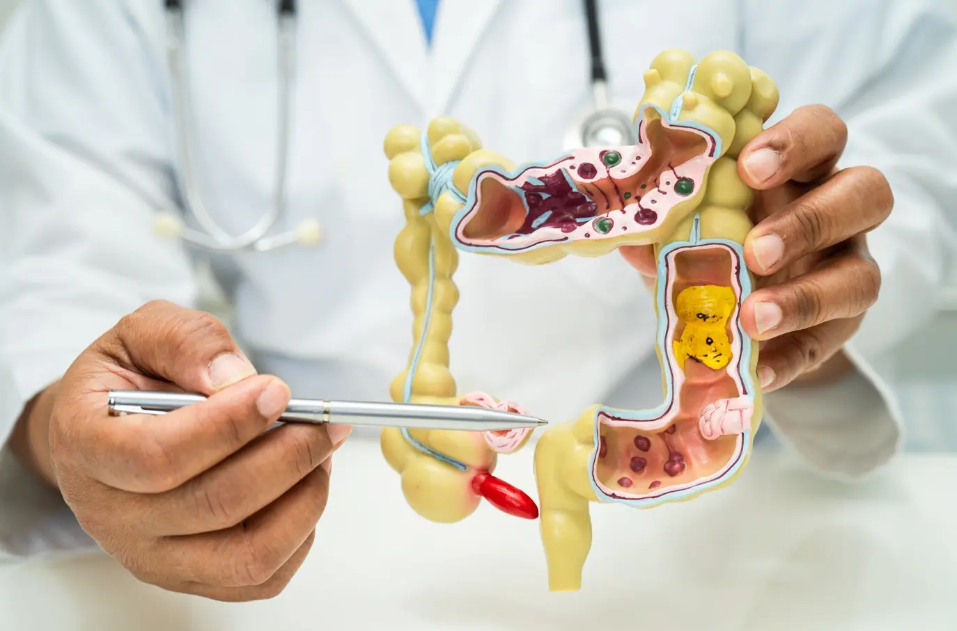New Research Finds 40-50% of Colon Cancer Cases Can Be Prevented by Doing These Simple Things