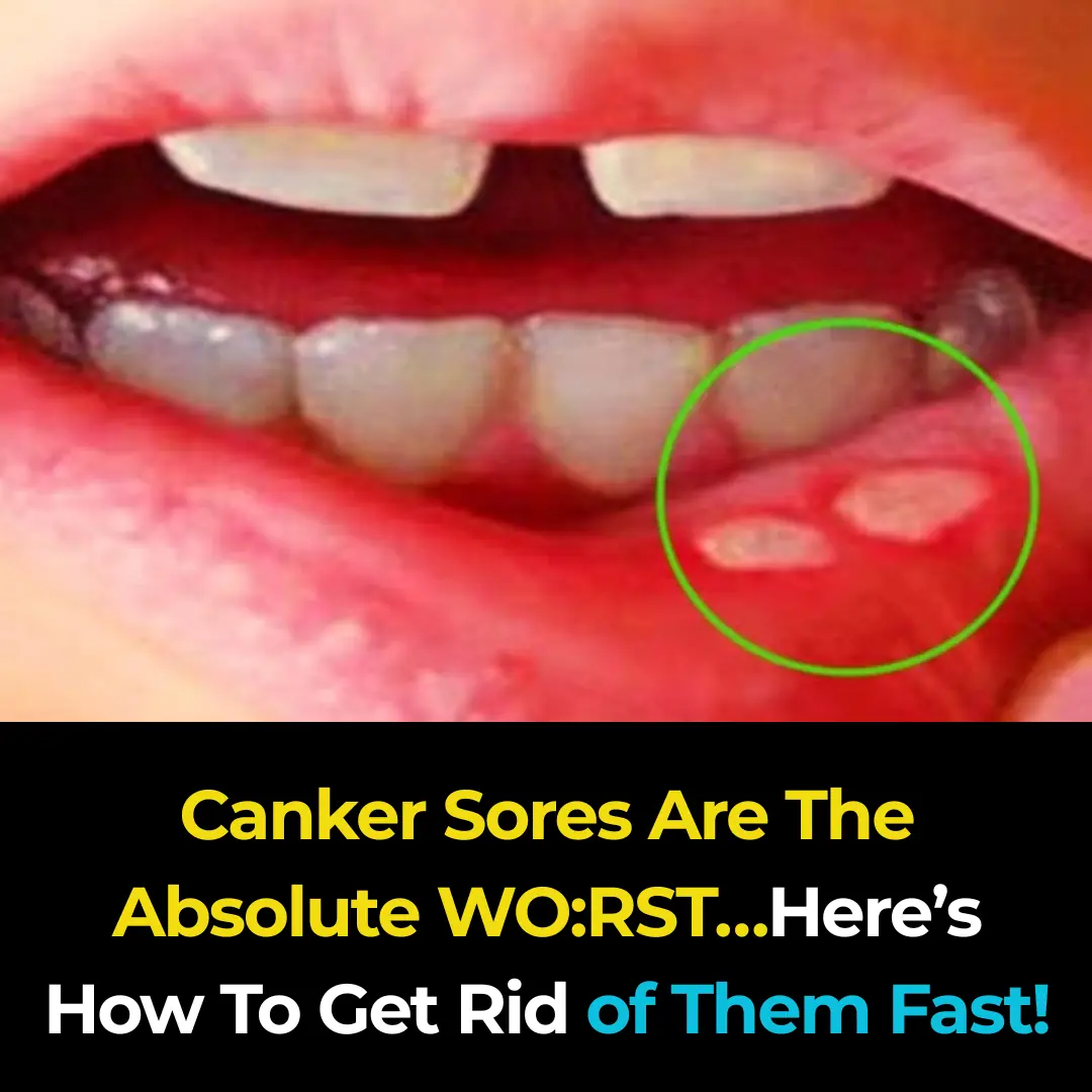 Canker Sores Are The Absolute WO:RST…Here’s How To Get Rid of Them Fast!