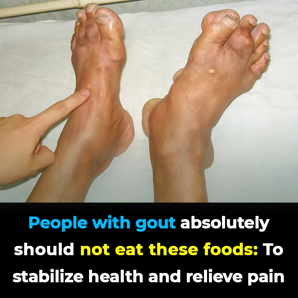 Foods Gout Patients Must Avoid at All Costs: Protect Your Health and Keep Painful Flare-Ups Away