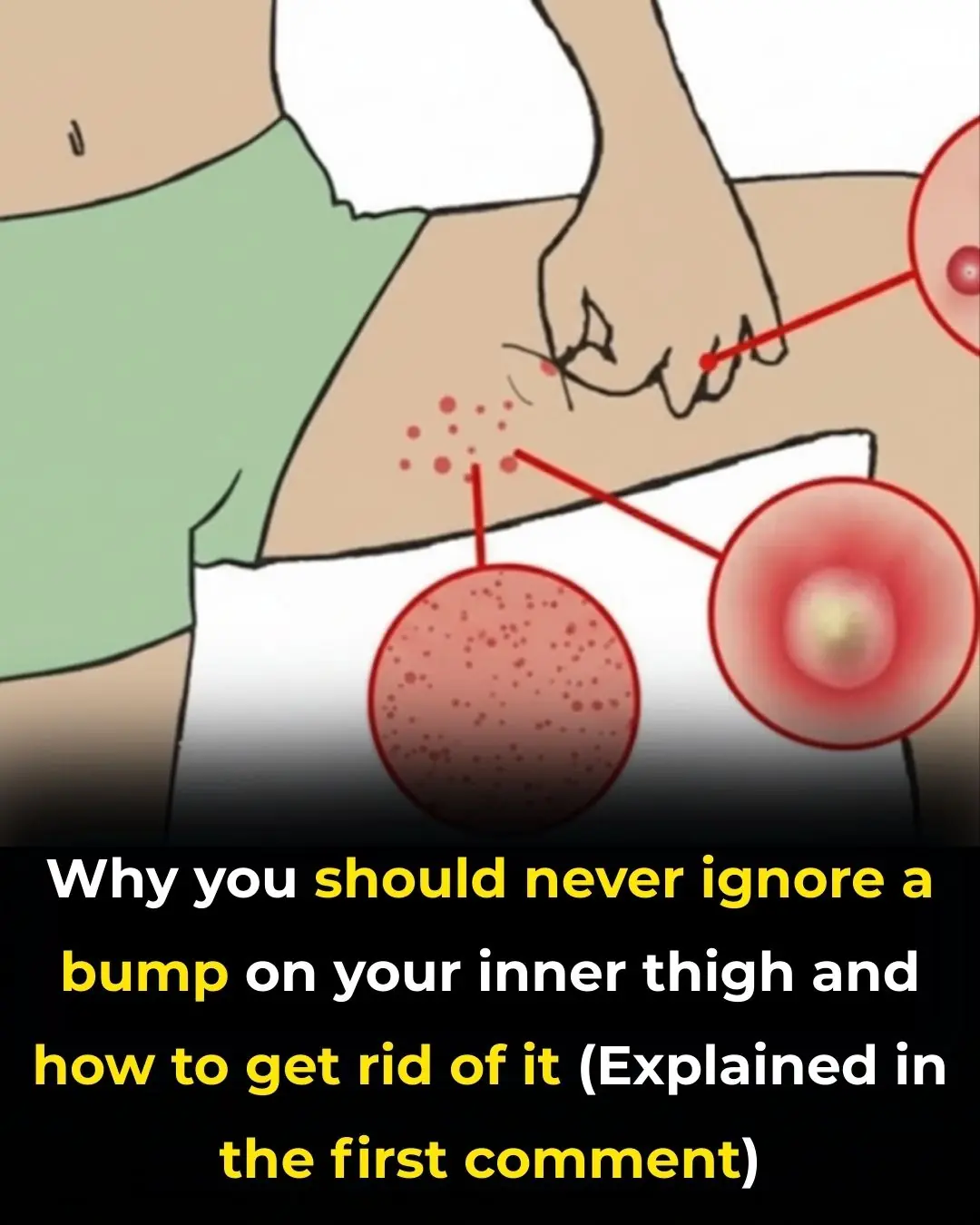 The Most Effective Ways to Get Rid of Bumps on Inner Thigh (Backed by Science)