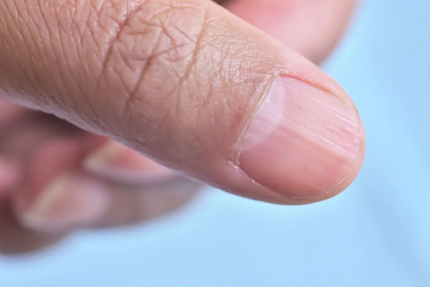 If you have these lines on your nails it is a clear sign that...