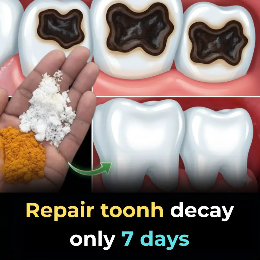 100% Natural Home Remedy for Tooth Decay, Yellow Teeth, and Tooth Pain