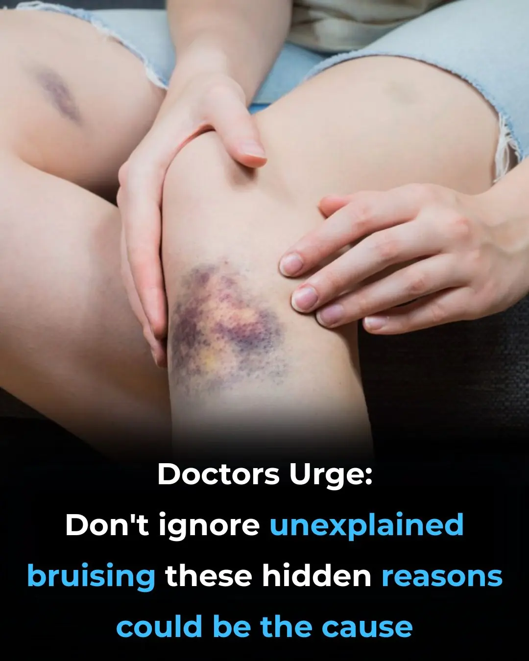 Unexplained Bruising on Your Body: Causes and Treatments