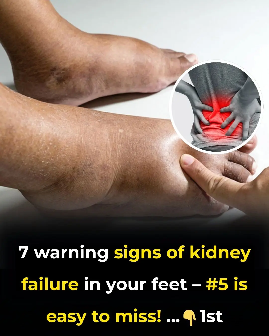 7 warning signs of kidney failure in your feet – #5 is easy to miss!