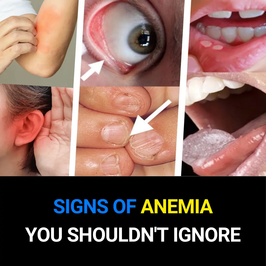 Silent Symptoms of Anemia You Should Never Ignore