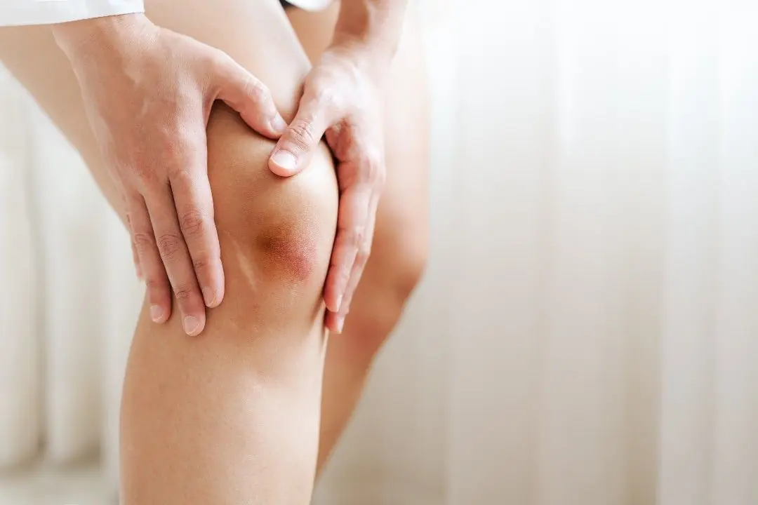 If You Get These Bruises on Your Body… Here’s What It Means