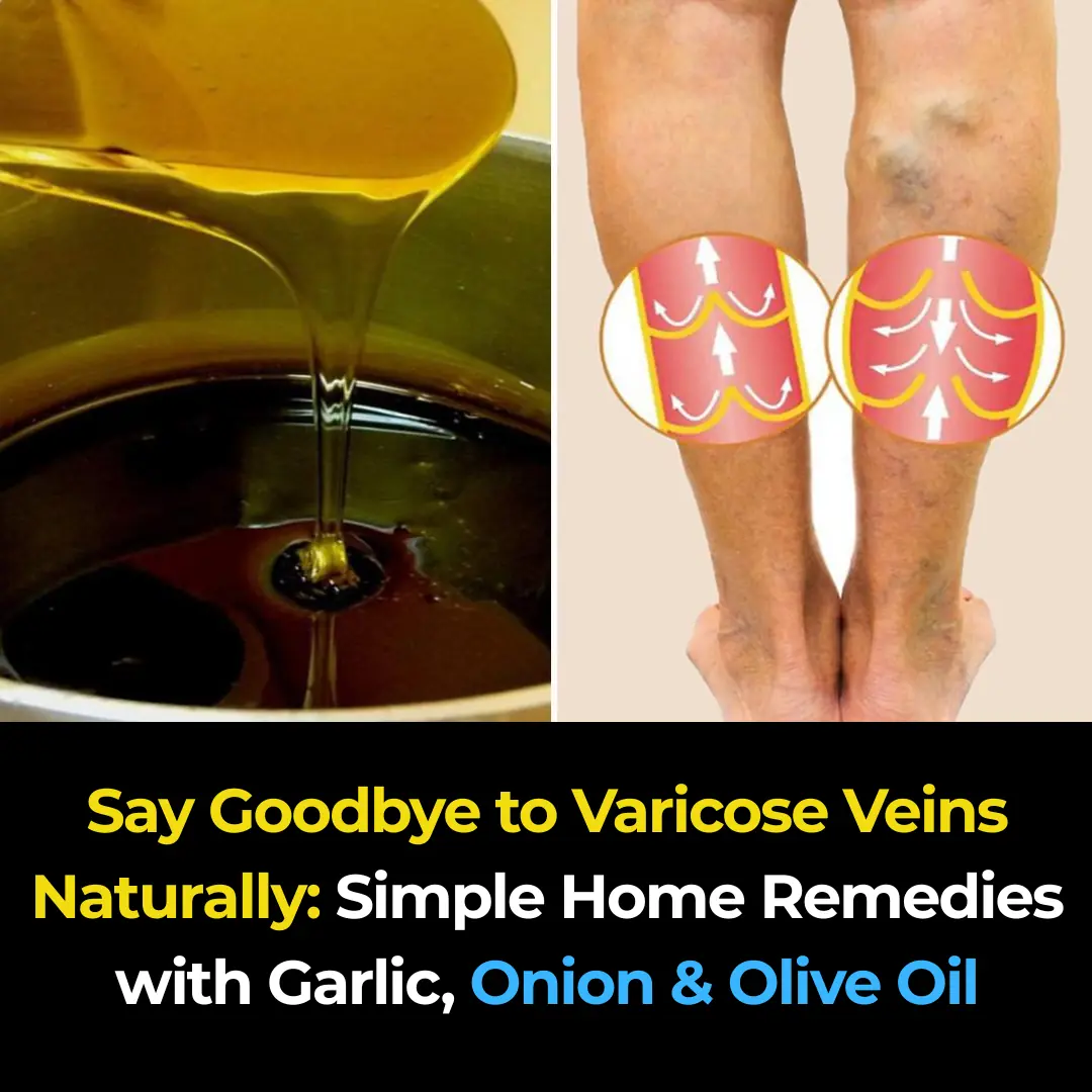 Onion, Garlic, and Olive Oil Remedy for Varicose Veins: Natural Treatment and Benefits