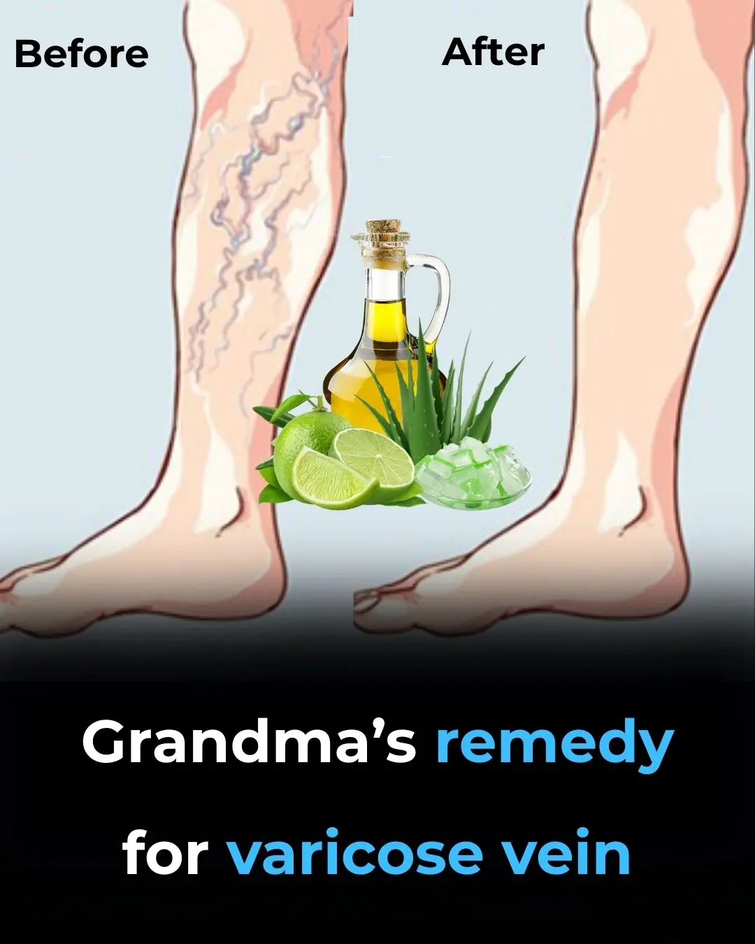 🌿 Grandma’s Remedy for Varicose Veins: A Natural Recipe with Aloe Vera, Apple Cider Vinegar, and Lemon