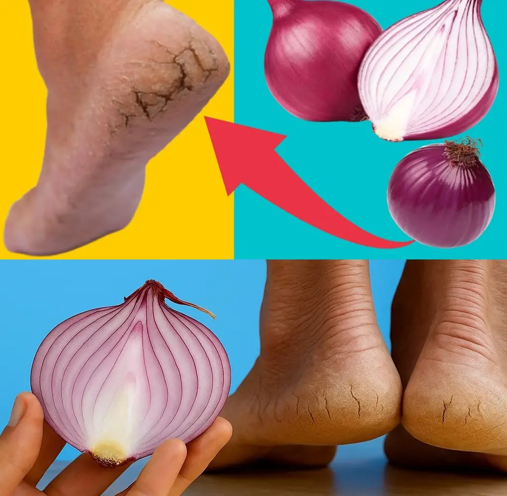 Onion Miracle: The Surprising Home Remedy to Heal Cracked Heels Fast
