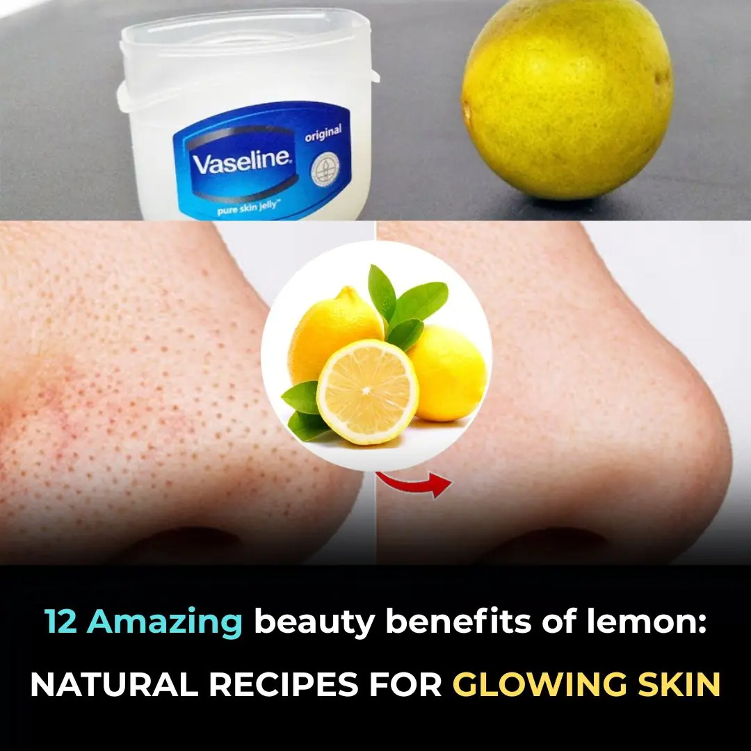 Top 5 Amazing Tips for getting rid of Blackheads and Whiteheads