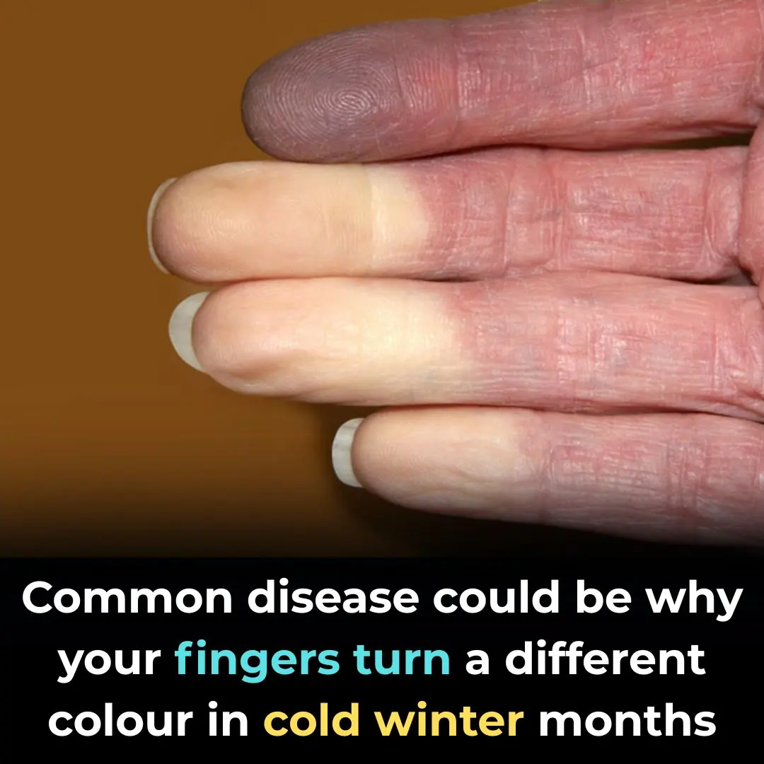 Why Your Fingers Turn a Different Colour