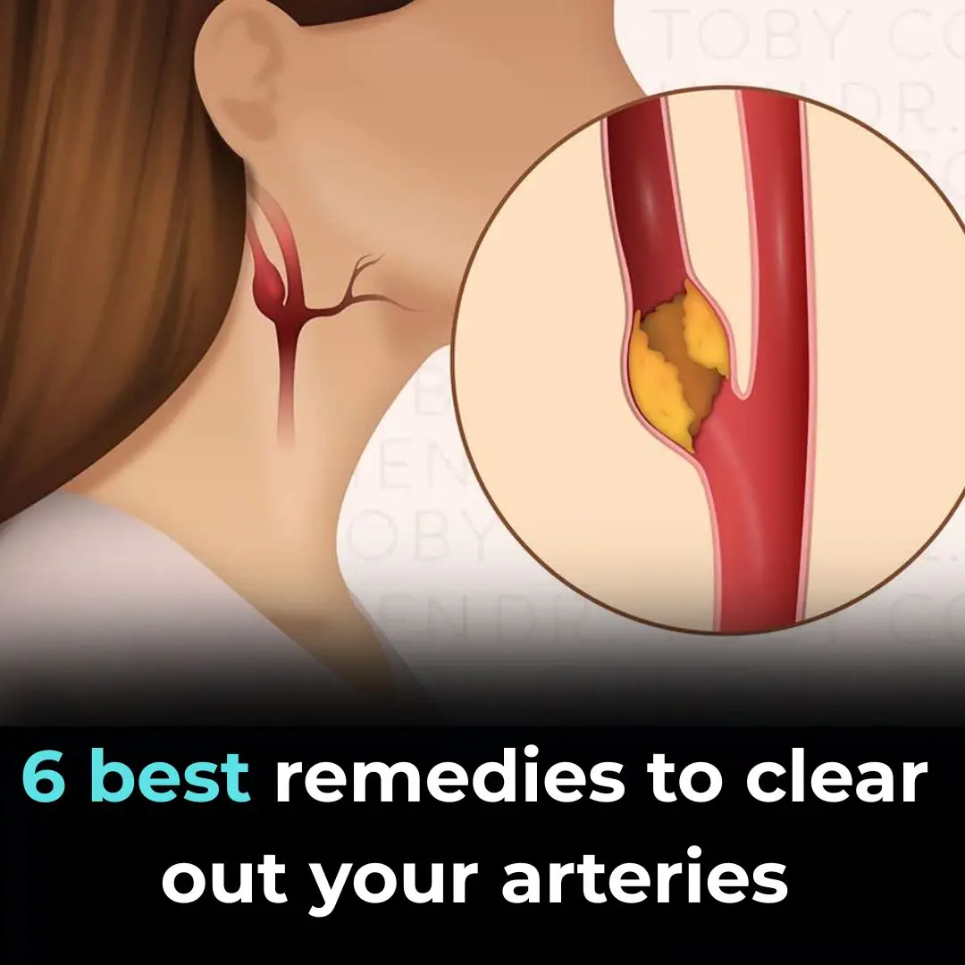 6 Best Remedies To Clear Out Your Arteries