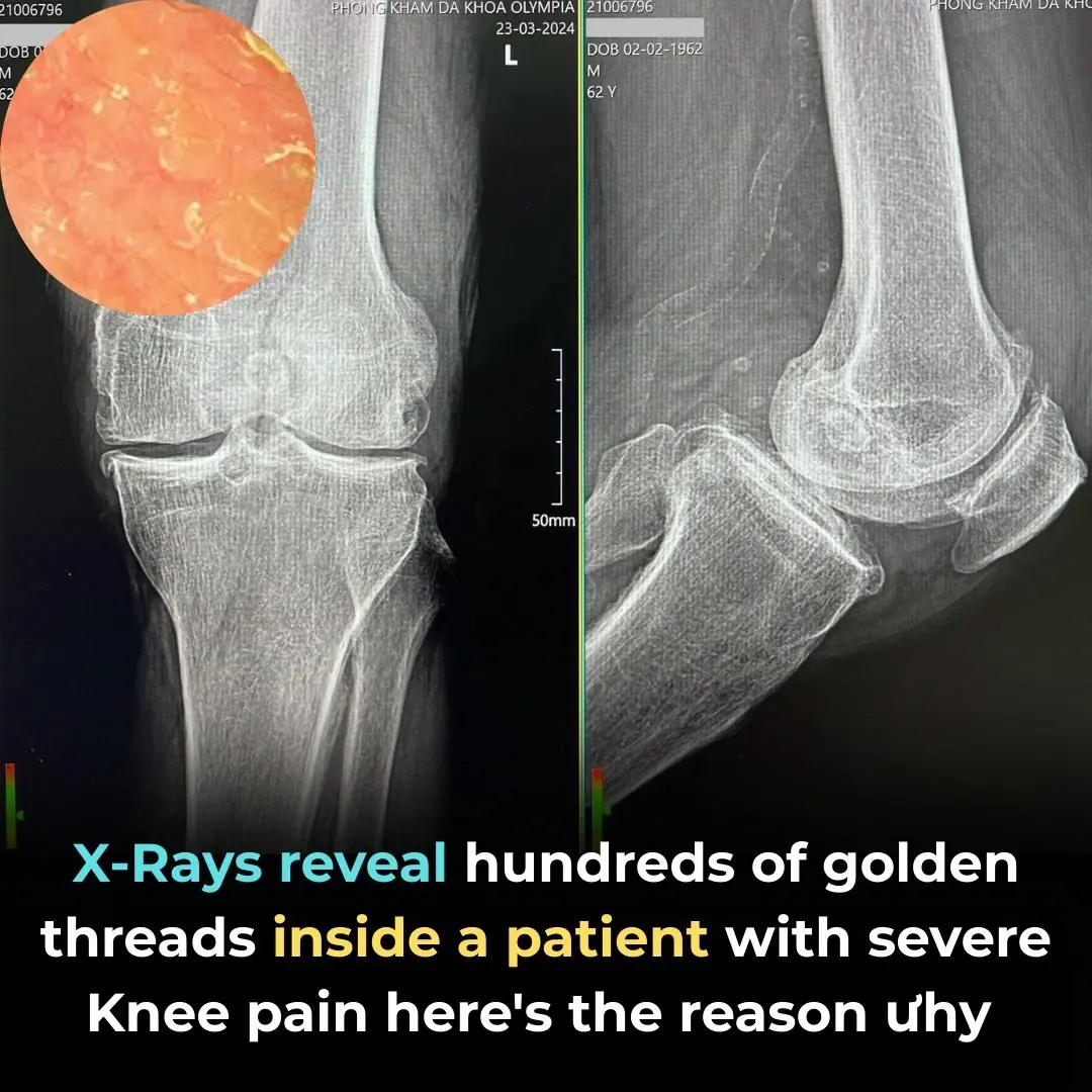 X-rays Reveal Hundreds of Golden Threads Inside a Patient with Severe Knee Pain — Here’s the Reason Why