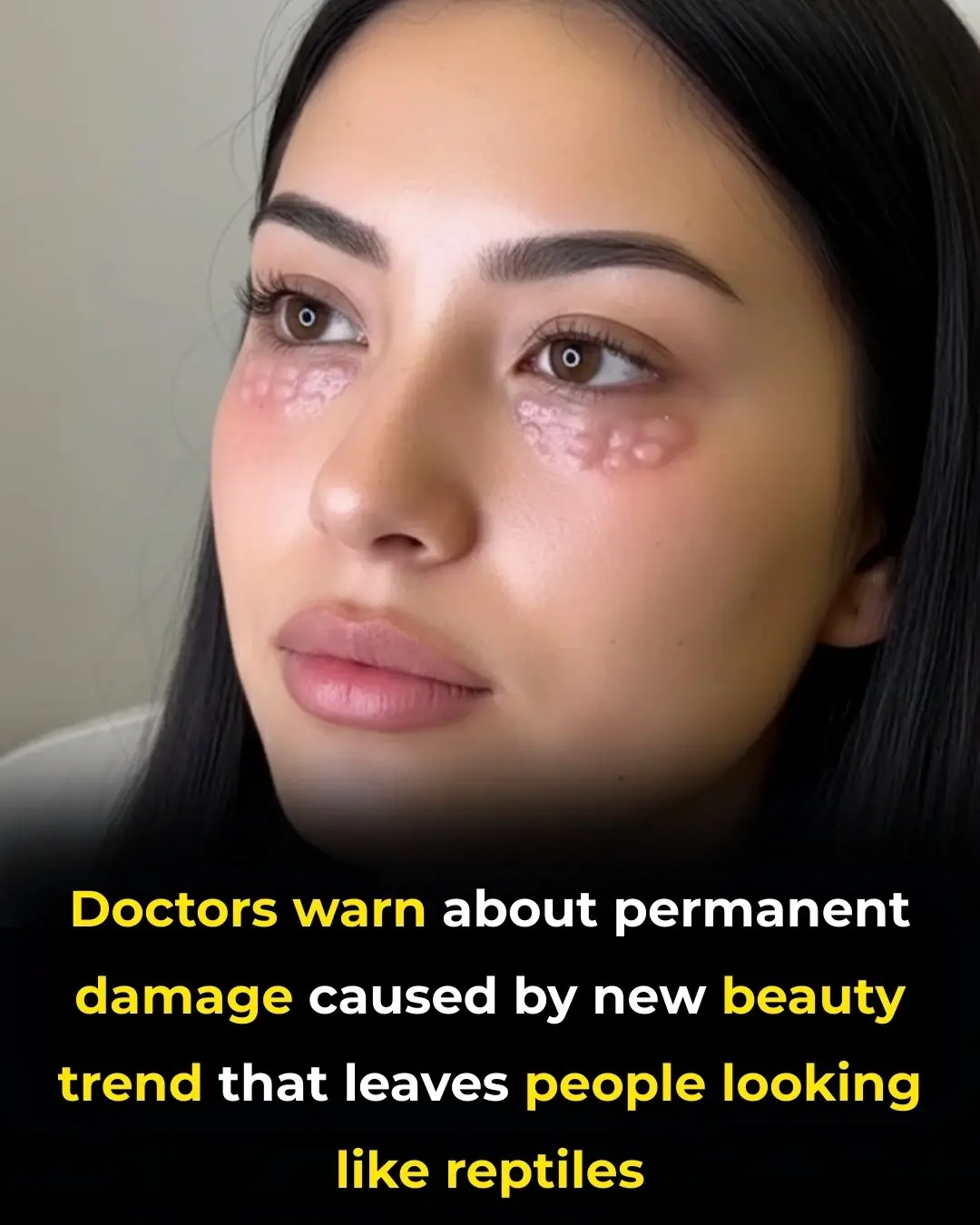Doctor Warns of Mesotherapy’s Risky Side, Causing Reptile-Like Skin