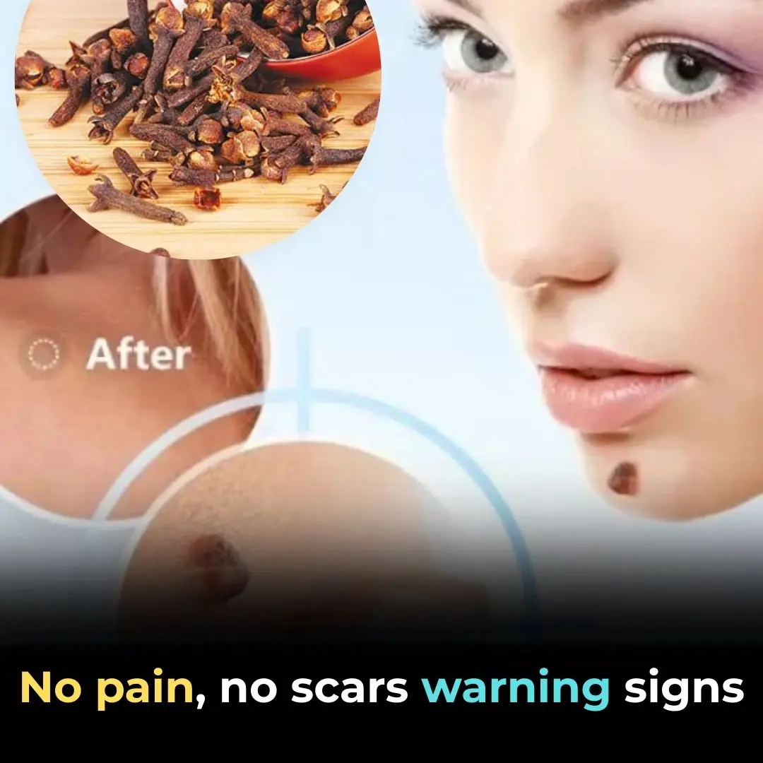 Cloves: A Natural Solution for Skin Tags and Warts