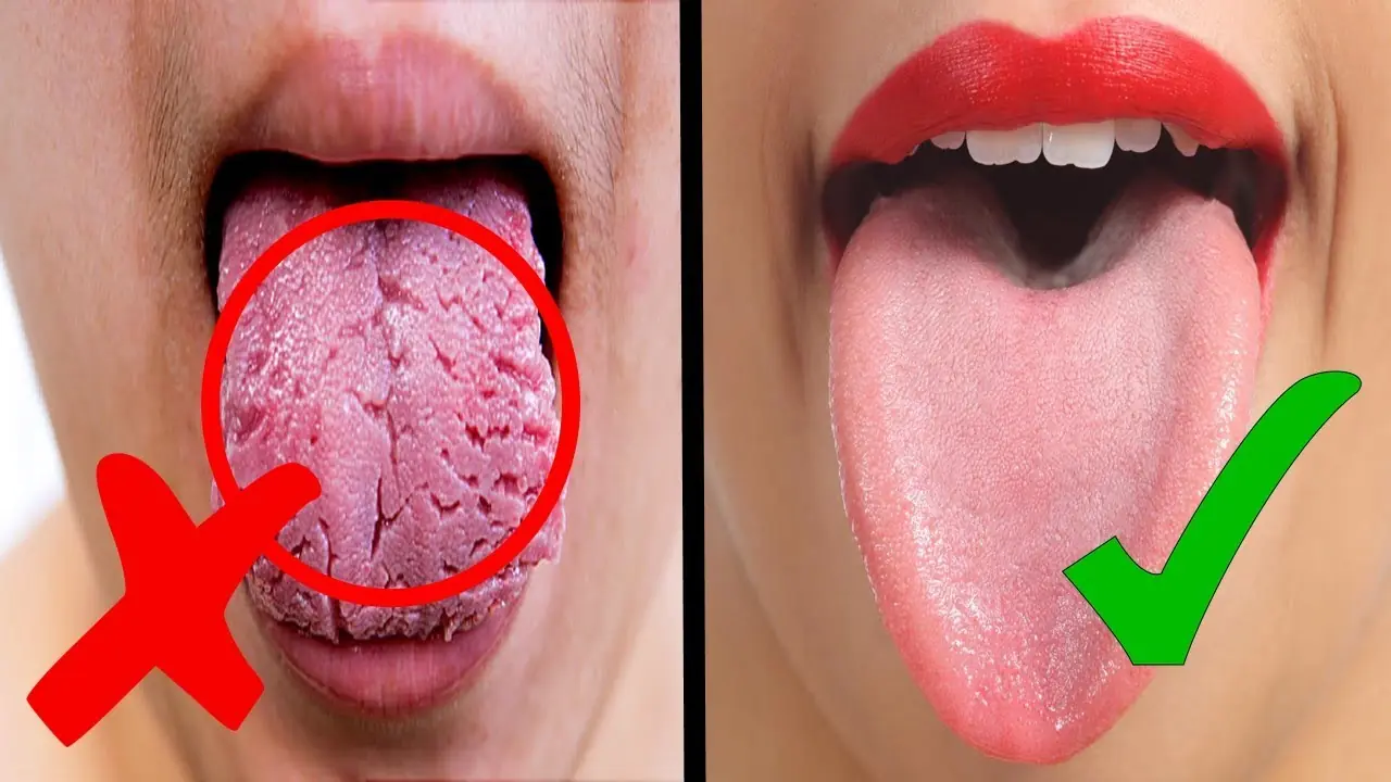 White Tongue: What It Means and What You Can Do About It