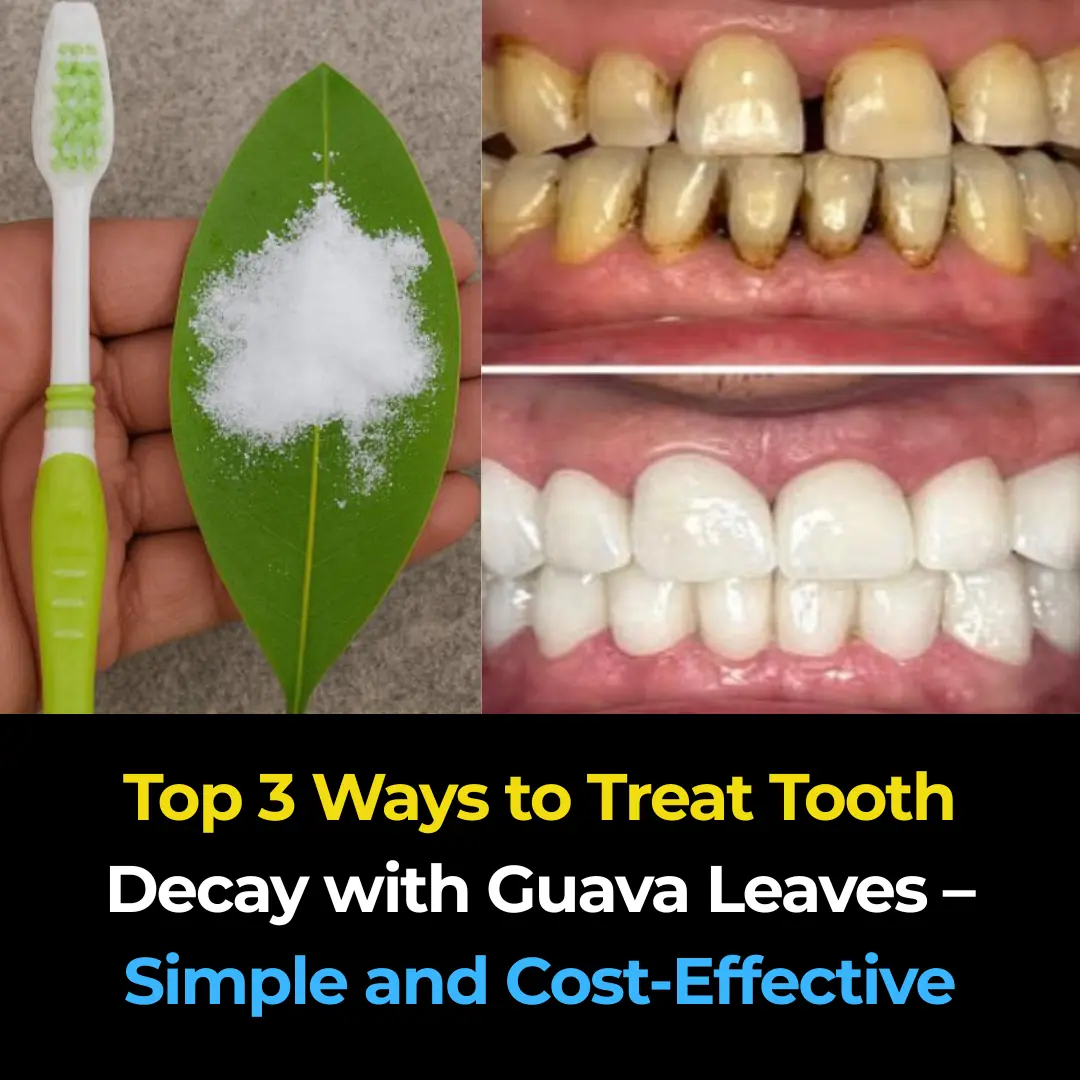 Top 3 Natural Remedies for Tooth Decay Using Guava Leaves